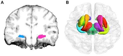 Identifying Morphological Patterns of Hippocampal Atrophy in Patients With Mesial Temporal Lobe Epilepsy and Alzheimer Disease